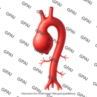 Aorta with aneurysm of the descending thoracic aorta