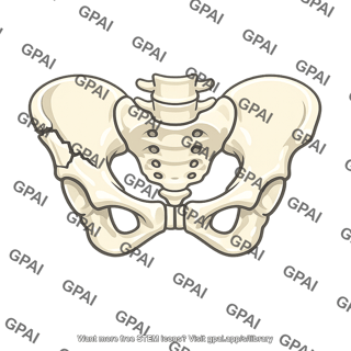 Pelvic fracture