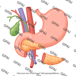 Pancreatectomy distal 207