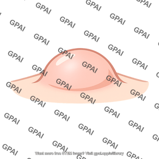 Soft tissue mass