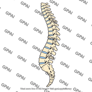 Lordosis