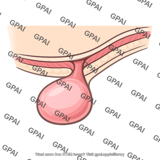 Inguinal hernia
