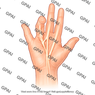 Hand dupuytren disease