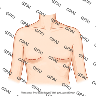 Double mastectomy postoperative appearance 524