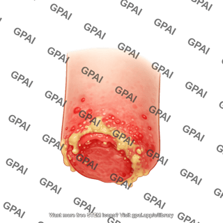 Limb amputation stump infected