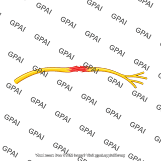 Damaged peripheral nerve