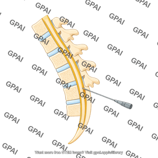 Lumbar puncture human