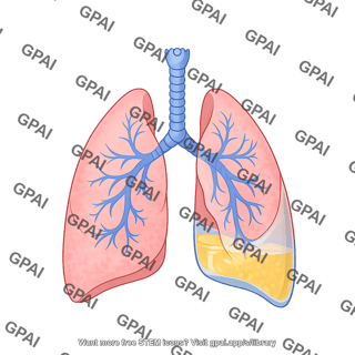 Lungs human pleural effusion