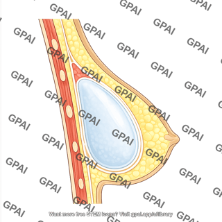 Breast sagittal cut with silicone implant