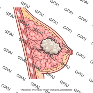 Breast cancer
