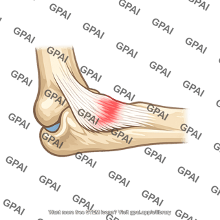 Medial epicondylitis