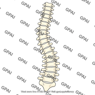 Scoliosis idiopathic