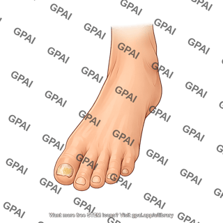 Foot onychomycosis