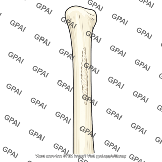 Coracobrachialis attachment ridge
