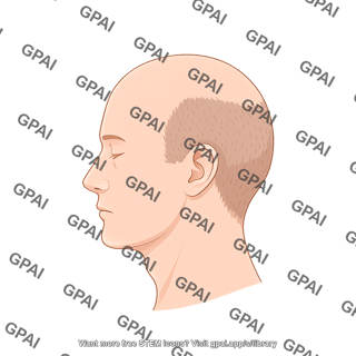 Male balding stage 2 lateral