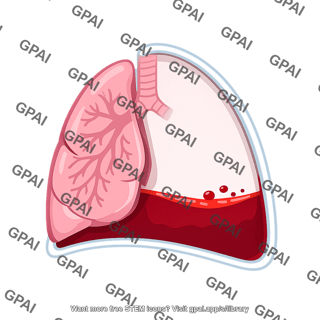 Hemothorax