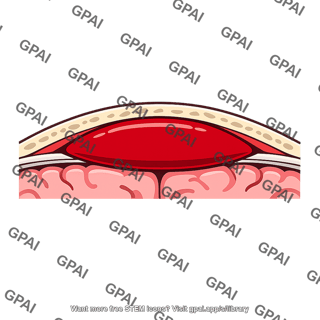 Epidural hematoma