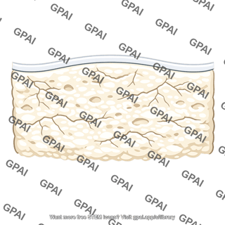 Subchondral bone fissured