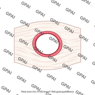 Fascia defect