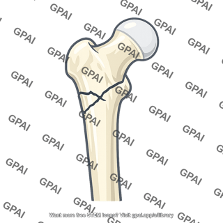 Intertrochanteric fracture
