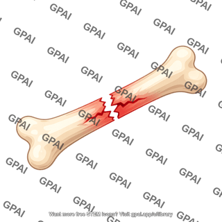 Fracture line transverse