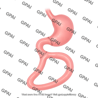 Billroth ii gastrojejunostomy