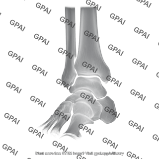 Ankle radiograph