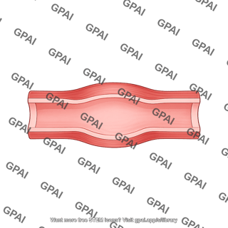 Blood vessel cut straight bulge