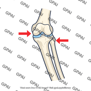Valgus stress