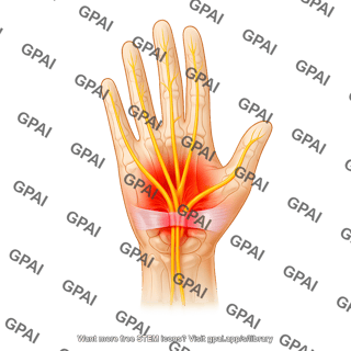 Carpal tunnel syndrome wth affected area