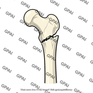 Proximal femur fracture