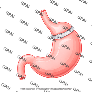 Stomach with gastric band 698