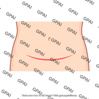 Pfannenstiel incision