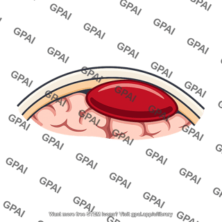 Extradural hemorrhage