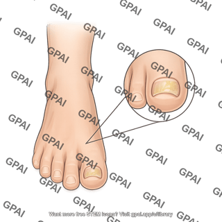 Foot human with onychomycosis callout