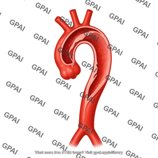 Aortic dissection debakey type 2