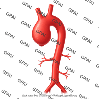 Aorta with aneurysm of the ascending aorta