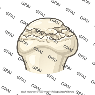 Femoral head necrotic