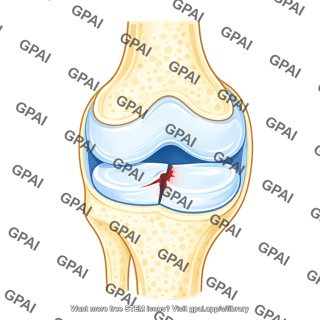 Knee meniscus lateral vertical tear