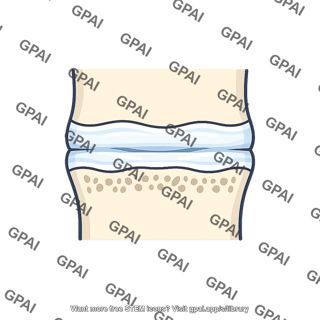 Growth plate compressed