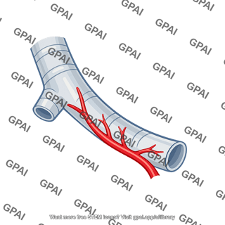 Inferior left bronchial artery