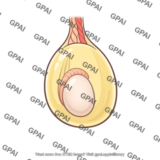 Hydrocele
