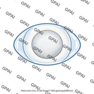 Lens cataract