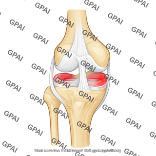 Knee joint acl patellar tendon inflamed meniscus