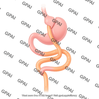 Roux en y gastric bypass