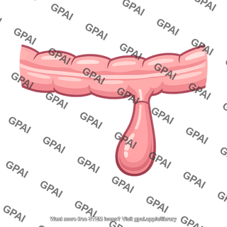Meckel diverticulum