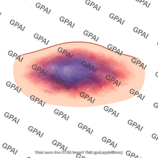 Soft tissue bruising