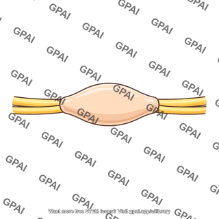 Nerve tumor benign
