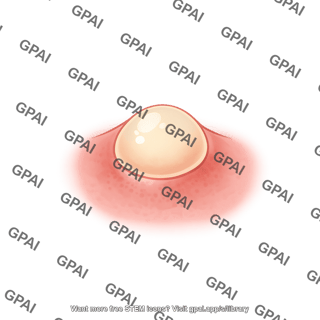 Acne pustule