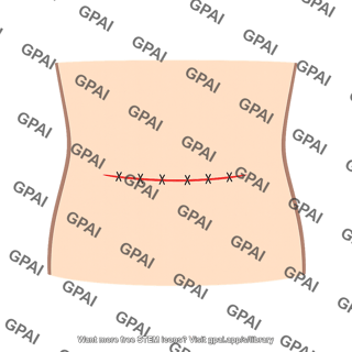 Abdominal incision